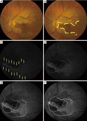 图2 存在睫状视网膜动脉供血的左眼CRAO。存在睫状视网膜动脉供血的左眼急性期CRAO的眼底彩照（A，B）和视网膜荧光素血管造影（C，D，E，F）（与图1为同一名患者）。（A）存在睫状视网膜动脉供血的左眼CRAO眼底彩照。存在一支睫状视网膜动脉供应乳斑束。（B）与（A）为同一张照片，标出了睫状视网膜动脉供血区（即黄线内的区域）。睫状视网膜动脉供血区外可见视网膜水肿。（C，D，E，F）分别为注射荧光素染料后21秒（C）、24秒（D）、28秒（E）和1分钟5秒（F）的荧光素血管造影片。注射荧光素染料后21秒可见乳斑束呈弱荧光（C中黄色箭头标注的区域），乳斑束外未见荧光信号。注射荧光素染料1分钟后（F），仍有许多血管节段无荧光信号（即呈黑色的视网膜血管节段），乳斑束外视网膜几乎无灌注。