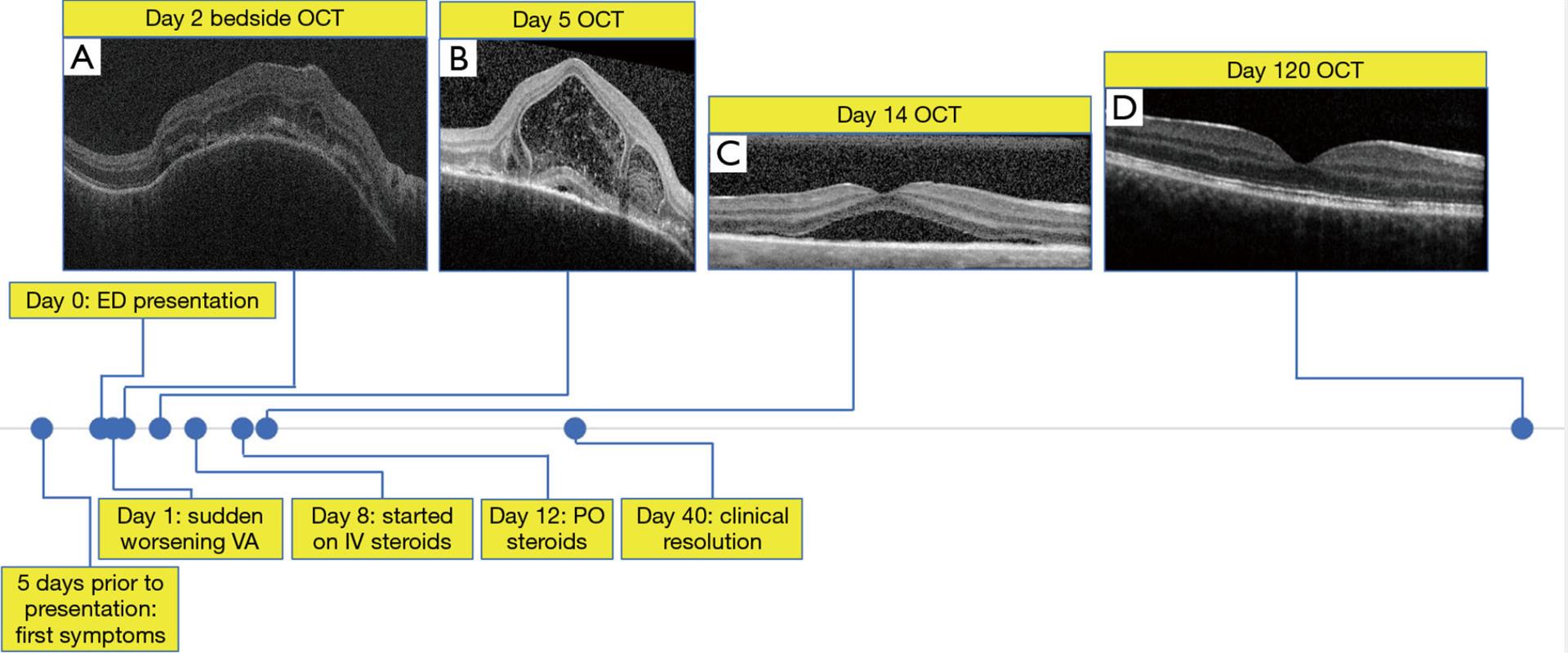 Figure 2 Timeline of the case labeled with key events and select OCT imaging; all images are the macula of the right eye. (A) Portable OCT of the macula performed at bedside on day 2 after initial presentation. (B) OCT of the macula 5 days after initial presentation demonstrating splitting of the myoid zone separating the ELM from the ellipsoid zone. (C) OCT of the macula after 1 week on high-dose steroids. (D) OCT of the macula 4 months after initial presentation. ED, emergency department; ELM, external limiting membrane; IV, intravenous; OCT, optical coherence tomography; PO, oral; VA, visual acuity.