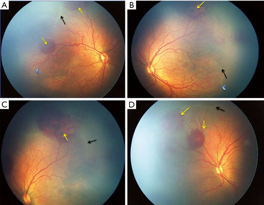 图1一名出生胎龄32周、出生体重2100g的新生儿男性在矫正胎龄36周表现出急进性后部型ROP，更像是混合型ROP（APROP和进展期ROP的结合）。右眼和左眼（A，B）均显示Ⅱ区视网膜后部无血管区伴plus病变。有平滑的新生血管（蓝色箭头）、大量视网膜前出血（黄色箭头）和不连续的界限不清的“嵴”（黑色箭头）形成提示进展期ROP。ROP：早产儿视网膜病变。