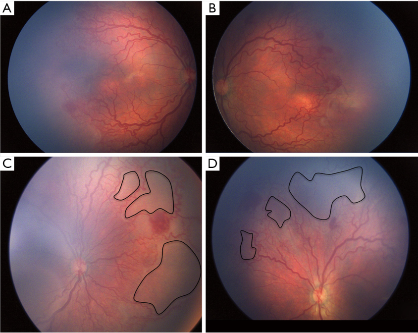 图2一名出生胎龄29周、出生体重1090g的新生儿女性在矫正胎龄31周时的表现。双眼（A，B）表现为Ⅰ区急进性后部型ROP伴严重plus病变。少量视网膜出血，最显著的是双眼多个不寻常的大环包围视网膜无血管区的形成（C，D黑线）。ROP：早产儿视网膜病变。